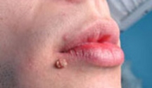 Появление герпеса на губах: лечение и профилактика