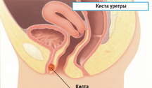 Опухоли и кисты уретры и мочевого пузыря